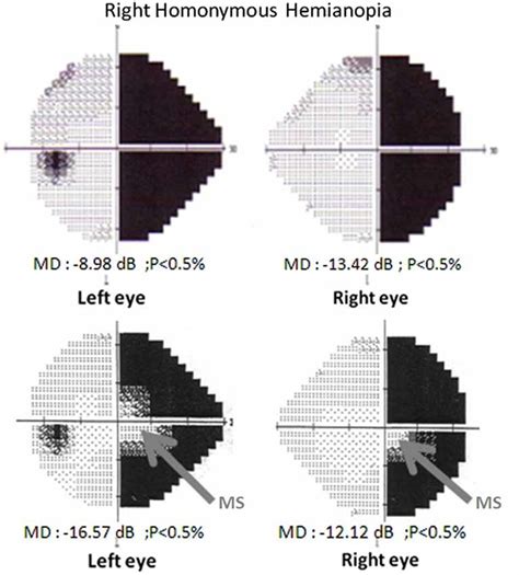 automated perimetry test results interpretation